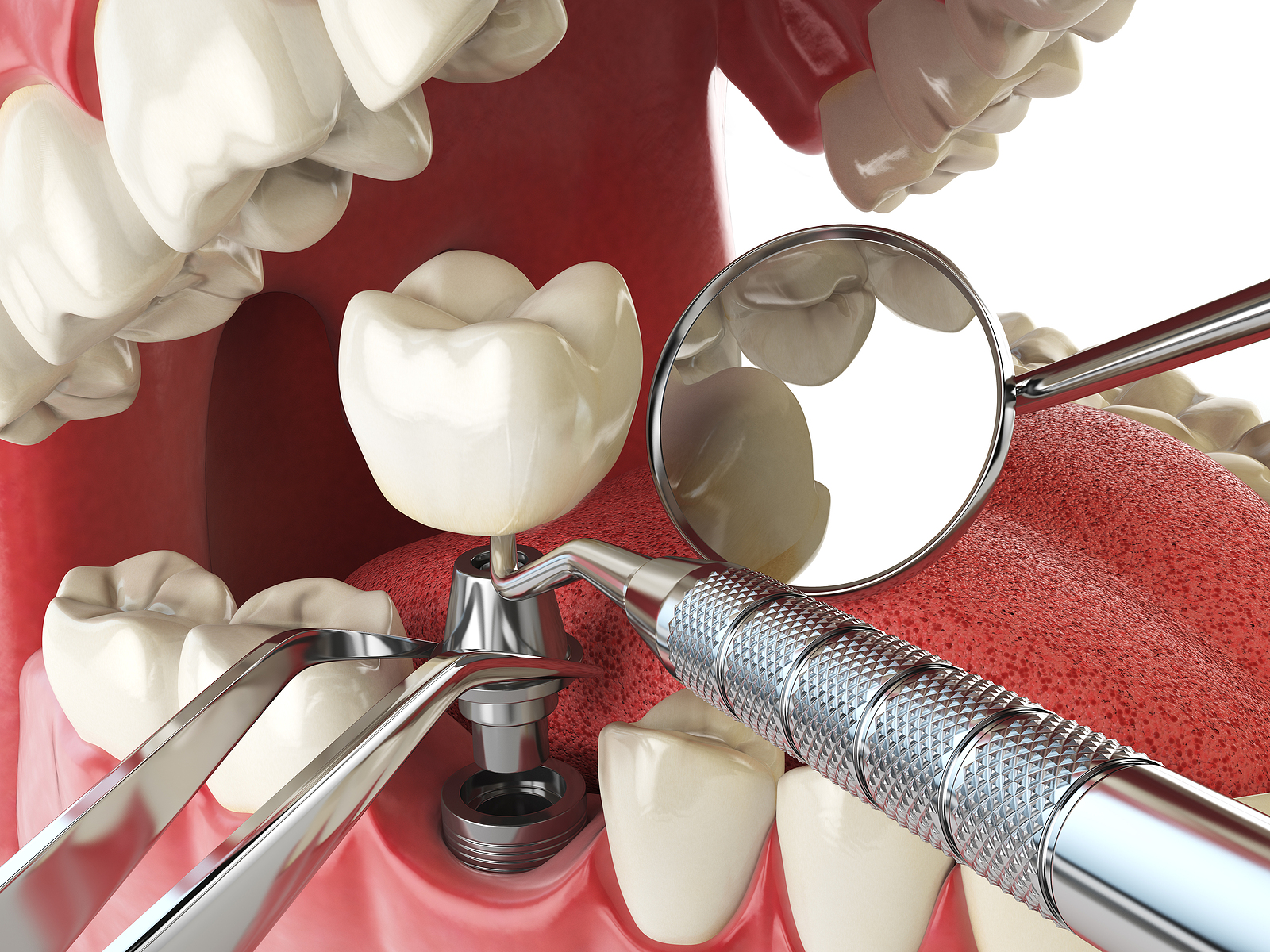 Dental implant treatment in the clinic