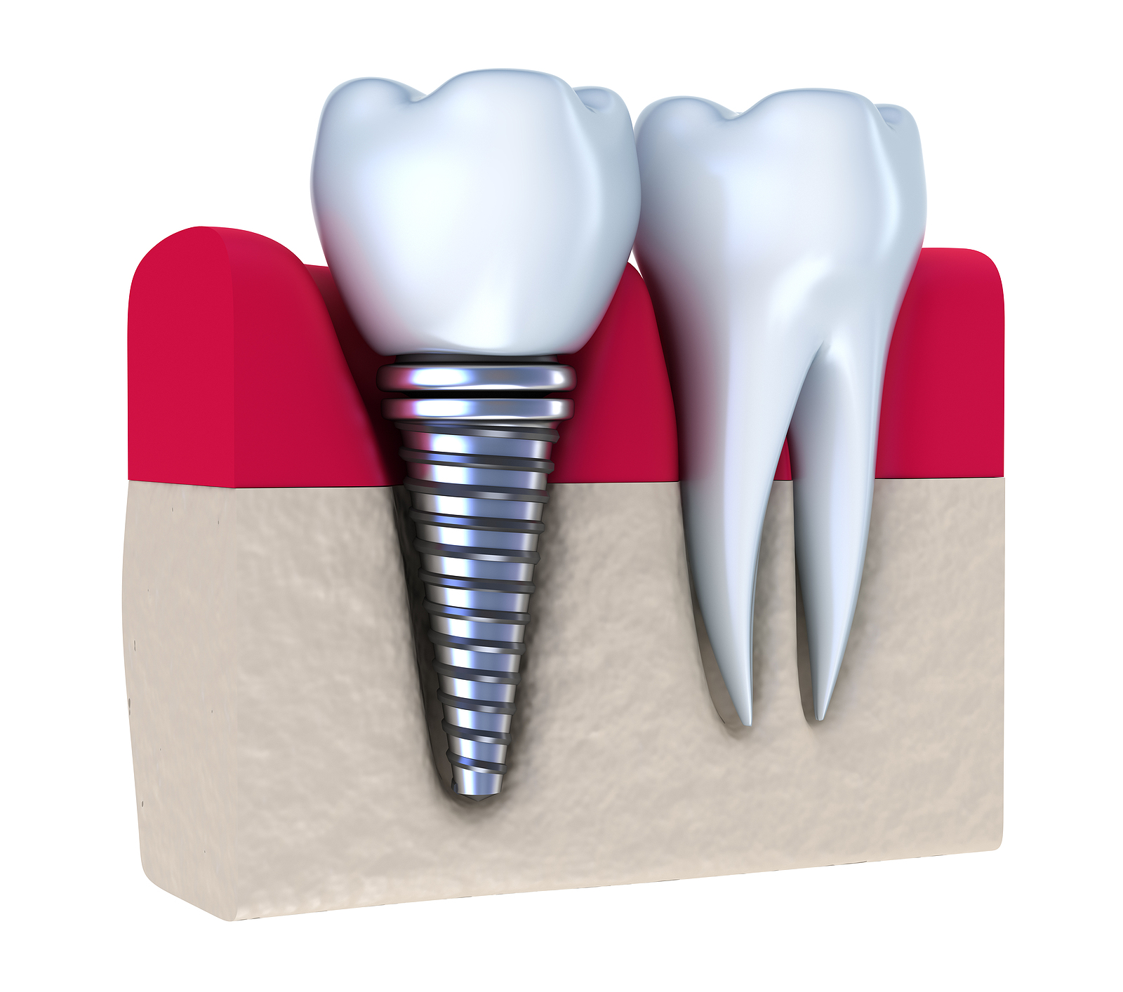 Dental implants in Redmond, CA